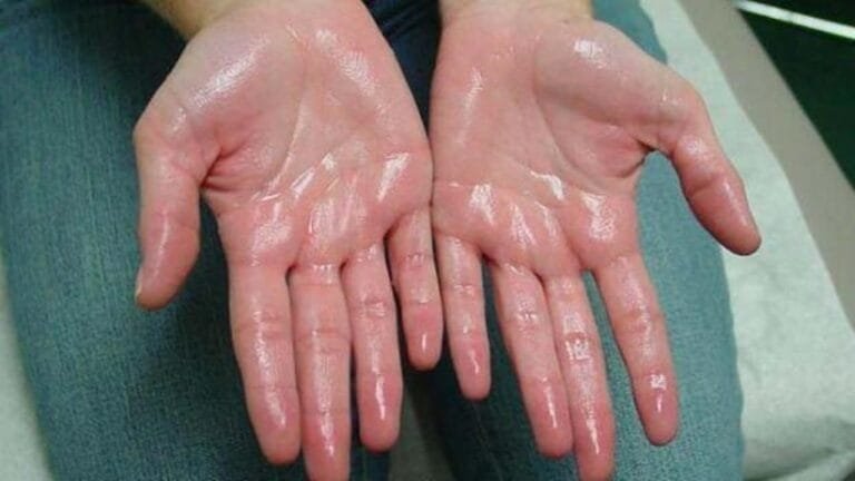 El terlemesi sorunu yaşayan kişi